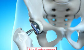 Hip Replacement Surgery