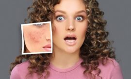 How Long Does It Take to Recover from Micro-needling for Acne Scars in Dubai
