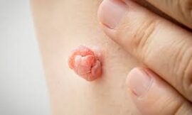 Is Cryotherapy a Safe Skin Tag Removal Option in Dubai