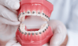 Is Early Bracing Safe for Kids? A Dentist Explains