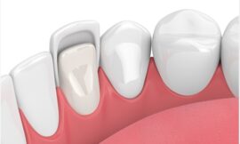 What Are the Most Common Mistakes to Avoid with Veneers in Dubai