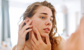 Clear Skin Naturally: Tips for Achieving Acne-Free Skin