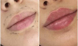Juvederm for Wrinkle-Free Skin: Discover the Benefits at the Best Aesthetic Clinic in dubai