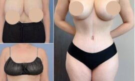 Tummy Tuck in Dubai: Why It’s the Best Option for a Firmer Abdomen