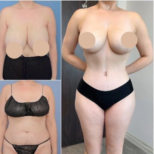 Read more about the article Tummy Tuck in Dubai: Why It’s the Best Option for a Firmer Abdomen