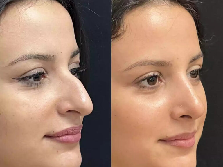 Read more about the article The Art of Rhinoplasty: Best Doctors in Dubai Lead the Way