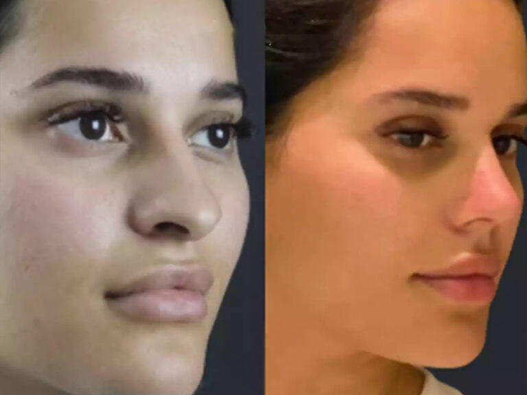 Read more about the article Why More People Are Choosing Nose Surgery in Dubai