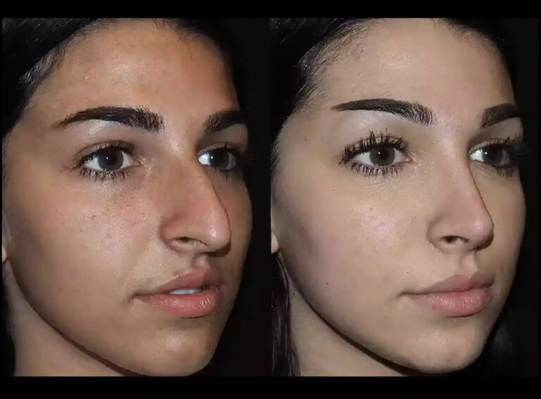Read more about the article Choosing the Best Septoplasty Surgeon in Dubai: A Patient’s Checklist