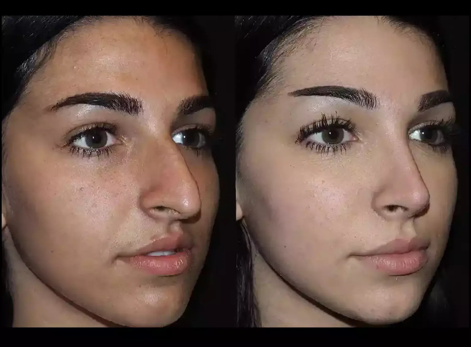 septoplasty in Dubai
