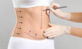 Is a Tummy Tuck in Dubai Suitable After Significant Weight Loss