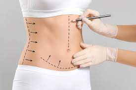 Read more about the article Is a Tummy Tuck in Dubai Suitable After Significant Weight Loss