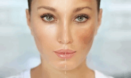 Are Chemical Peels Safe for Melasma on Darker Skin Tones in Dubai