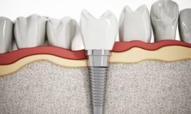 Are Dental Implants in Dubai Worth the Cost Compared to Dentures