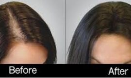 Are PRP Results Permanent or Will I Need Regular Maintenance