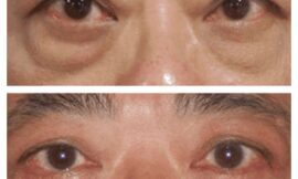 Understanding Lower Eyelid Surgery: Advice from the Best Eye bag removal Surgeon in dubai
