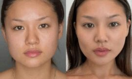 What is the Recovery Process Like? Advice from the Best Buccal fat removal Surgeon in dubai