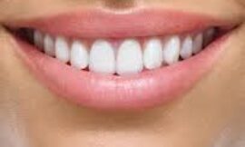 Can E-Max Veneers Be Repaired if Damaged in Dubai’s Climate