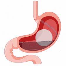 Read more about the article Can I Exercise with a Gastric Balloon in Dubai