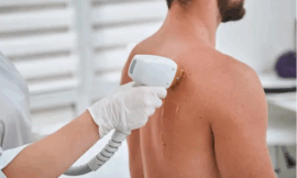 Can You Go Back to Work Immediately After Laser Hair Removal in Dubai