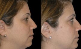 Best Double chin removal Surgeon in dubai: Transforming Your Profile with Precision and Care