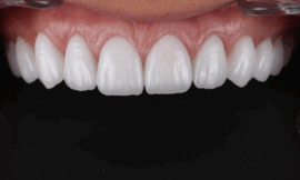 Dental Veneers: What to Expect During the Procedure