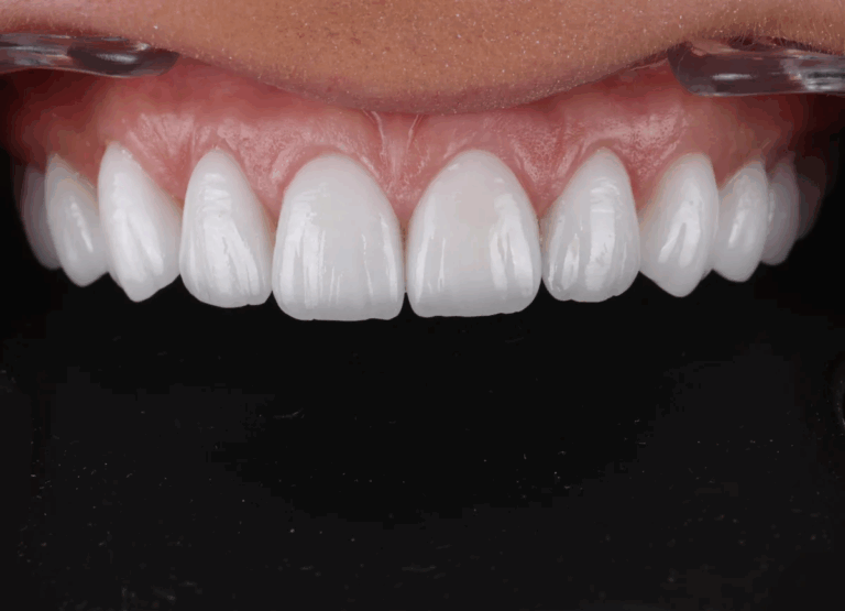 Read more about the article Dental Veneers: What to Expect During the Procedure
