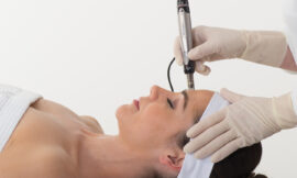 Discover Freedom from Melasma: Microneedling Success Stories