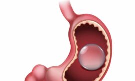 Does the Gastric Balloon Hurt During or After the Procedure in Dubai