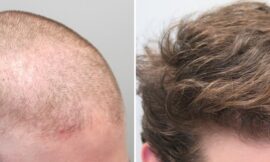 FDA Warns of Potential Side Effects Linked to Hair-Loss Drug Finasteride