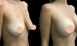What to Expect Before, During, and After Breast Augmentation in Dubai