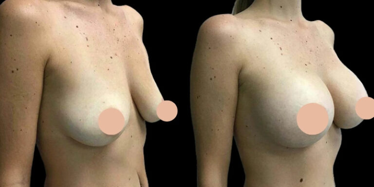 Read more about the article What to Expect Before, During, and After Breast Augmentation in Dubai