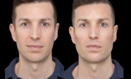 Why Cheek Fillers Treatments in Dubai Are a Great Way to Look Younger Without Surgery
