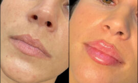 Meet the Best Doctors in dubai for Fillers: Experts in Cosmetic Surgery