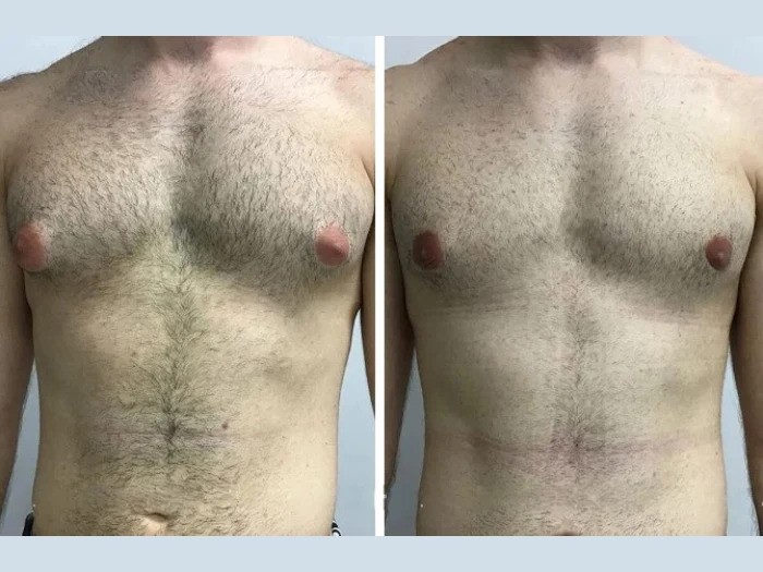 Read more about the article Best Doctors in Dubai for Gynecomastia: Choosing the Right Surgeon