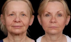 The Top Clinics Offering Under Eye Fillers Treatments in Dubai