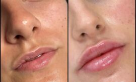 Meet Best Doctors in dubai for Fillers: Experts in Cosmetic Surgery