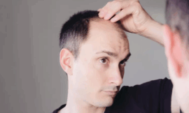 From Procedure to Perfection: The Role of Technology in Faster Hair Transplant Recovery