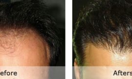 Hair Transplant In Rawalpindi