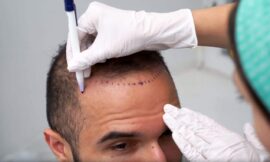 What Is A Hair Transplant?