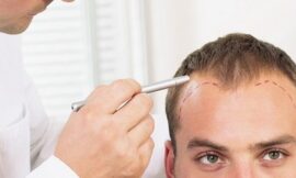 Hair Transplant for Baldness