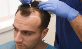 Speeding Up the Hair Transplant Journey: The Future of Faster Healing