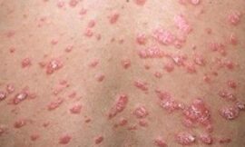 How Can I Tell If My Skin Allergy Is Caused by Pollution in Dubai