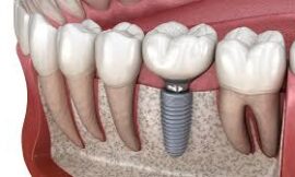 How Do I Know If I’m a Good Candidate for Dental Implants in Dubai