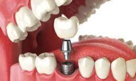 How Long Does the Full Dental Implant Process Take in Dubai