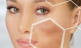 How Safe Are Chemical Peels for Melasma in Dubai