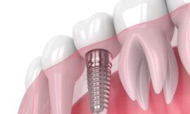 How Soon Can I Eat Normally After Getting Dental Implants in Dubai