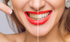 Maintain Your Glow with Teeth Whitening