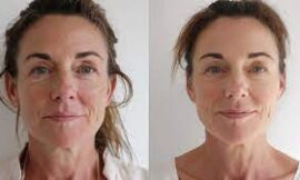 Transform Your Skin: How Microneedling Improves Melasma