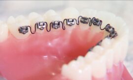 Why More Adults Are Getting Braces in Their 40s