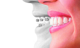 Straighten Your Smile with Confidence: Invisalign and Expert Orthodontic Care